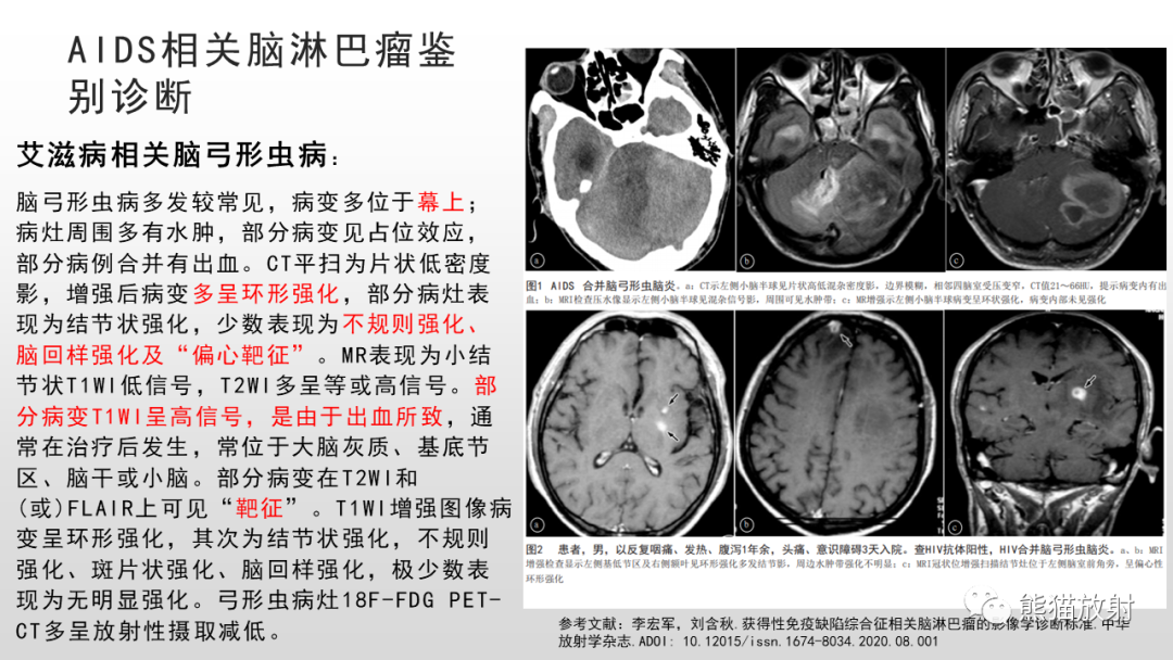 影像PPT - 【PPT】脑淋巴瘤 VS 胶质母细胞瘤-40