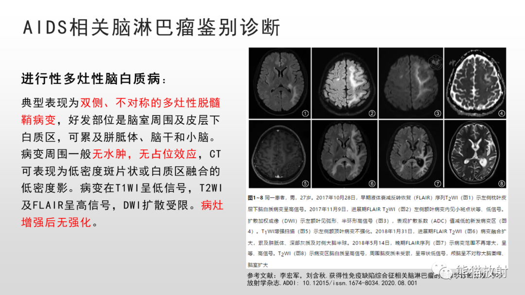 影像PPT - 【PPT】脑淋巴瘤 VS 胶质母细胞瘤-41