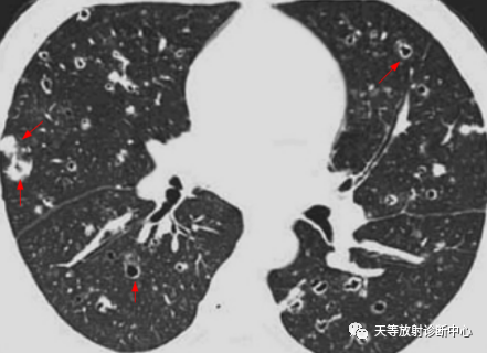 影像PPT - 肺组织细胞增生症X—朗罕细胞组织细胞增生症-1 影像PPT - 肺组织细胞增生症X—朗罕细胞组织细胞增生症-1