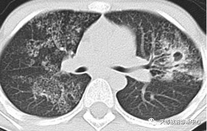 影像PPT - 肺组织细胞增生症X—朗罕细胞组织细胞增生症-3 影像PPT - 肺组织细胞增生症X—朗罕细胞组织细胞增生症-3