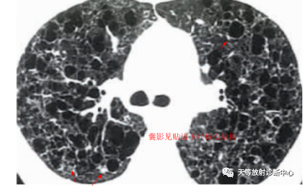 影像PPT - 肺组织细胞增生症X—朗罕细胞组织细胞增生症-5 影像PPT - 肺组织细胞增生症X—朗罕细胞组织细胞增生症-5