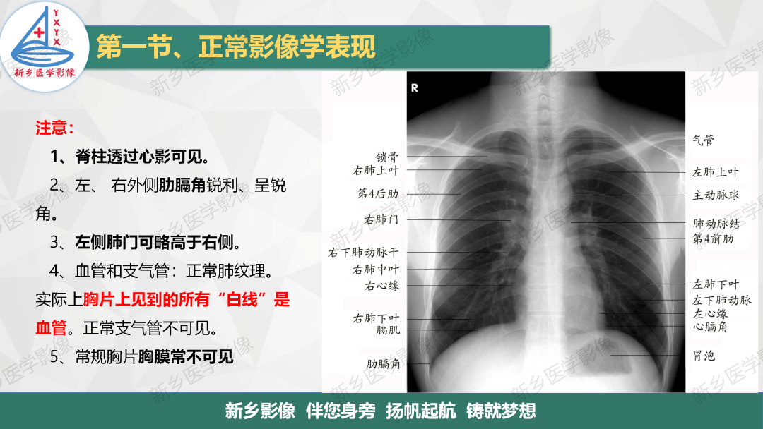 影像PPT - 【PPT】医学影像诊断学教材解读—呼吸系统疾病-3
