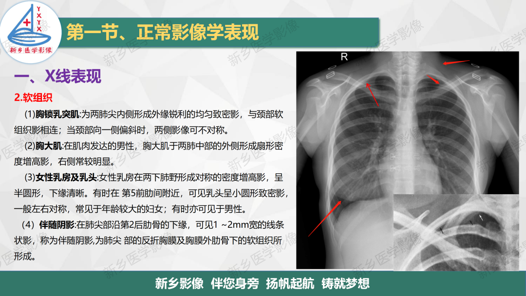 影像PPT - 【PPT】医学影像诊断学教材解读—呼吸系统疾病-9