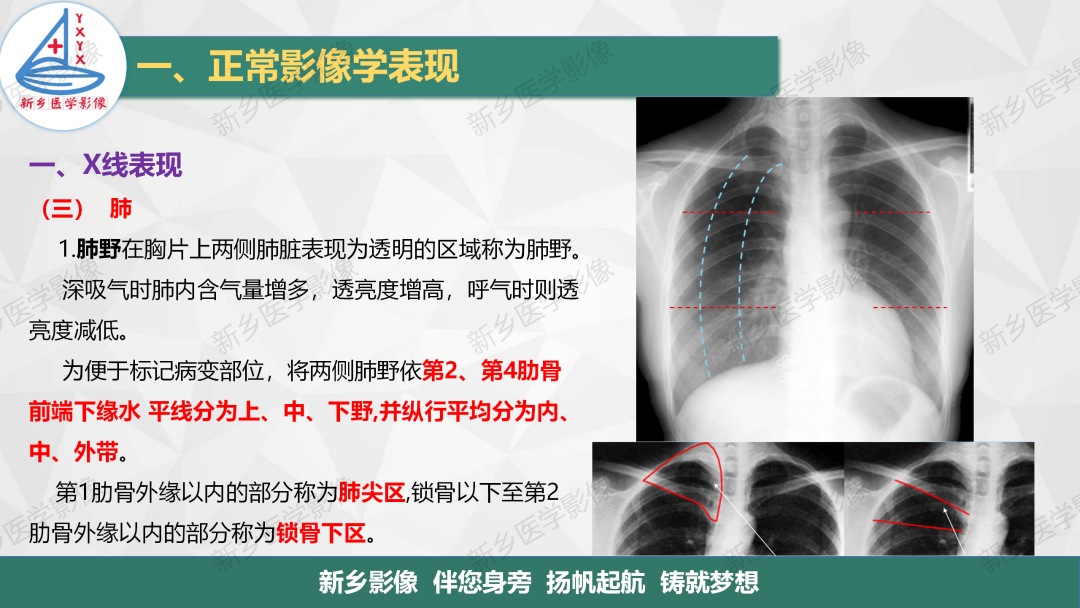 影像PPT - 【PPT】医学影像诊断学教材解读—呼吸系统疾病-11