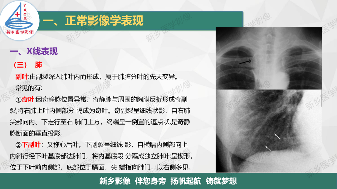 影像PPT - 【PPT】医学影像诊断学教材解读—呼吸系统疾病-13