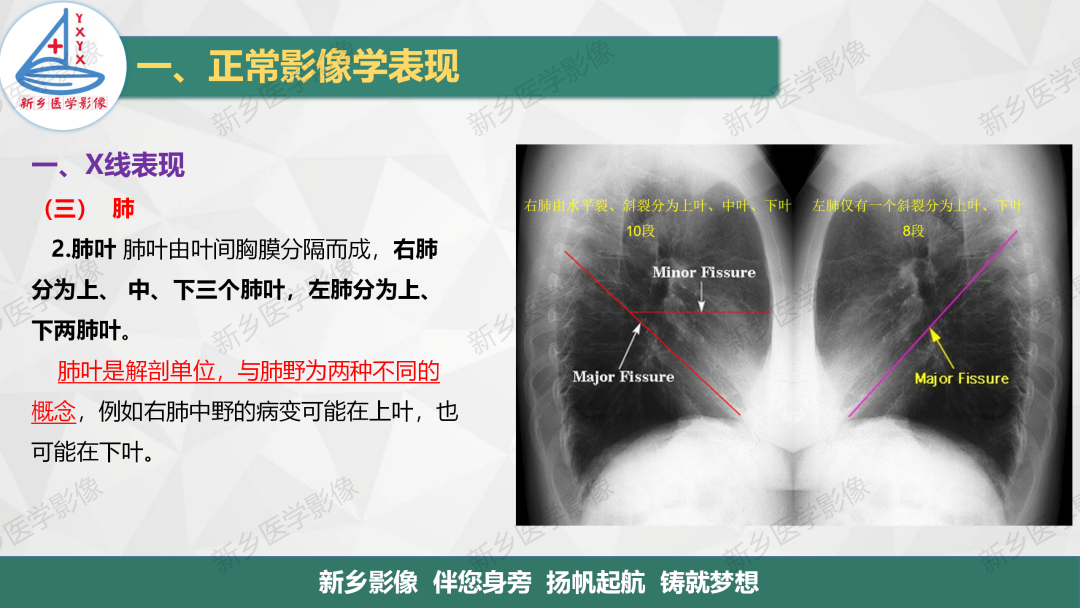 影像PPT - 【PPT】医学影像诊断学教材解读—呼吸系统疾病-12