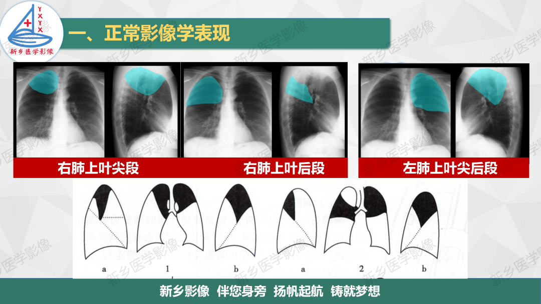影像PPT - 【PPT】医学影像诊断学教材解读—呼吸系统疾病-15