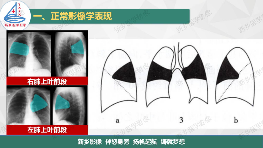 影像PPT - 【PPT】医学影像诊断学教材解读—呼吸系统疾病-16