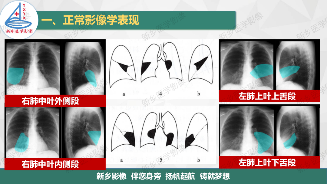 影像PPT - 【PPT】医学影像诊断学教材解读—呼吸系统疾病-17