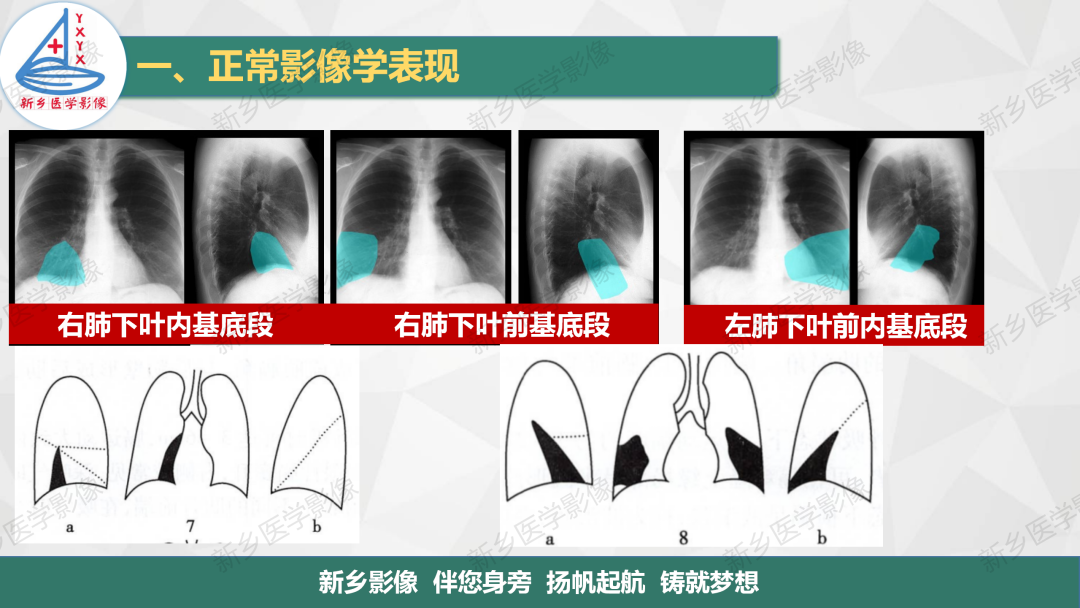 影像PPT - 【PPT】医学影像诊断学教材解读—呼吸系统疾病-19