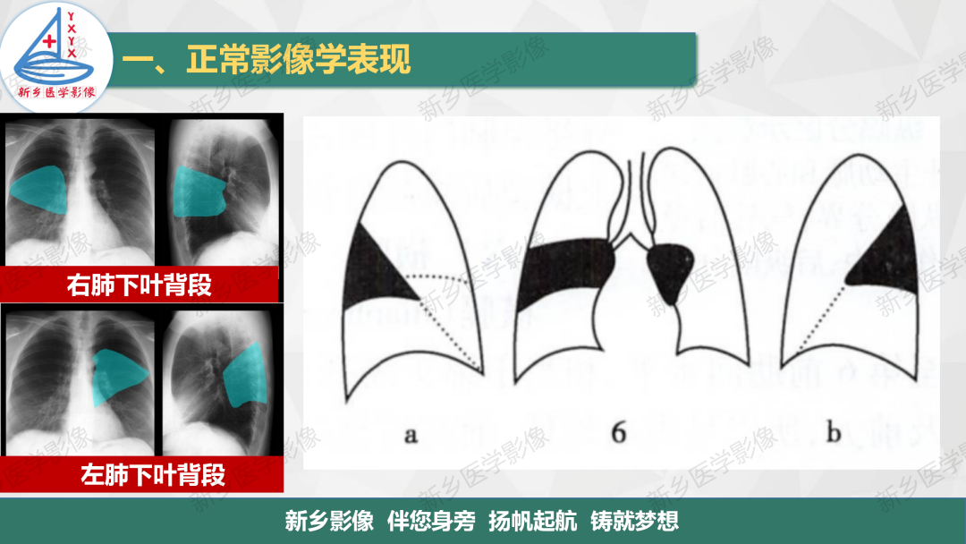 影像PPT - 【PPT】医学影像诊断学教材解读—呼吸系统疾病-18
