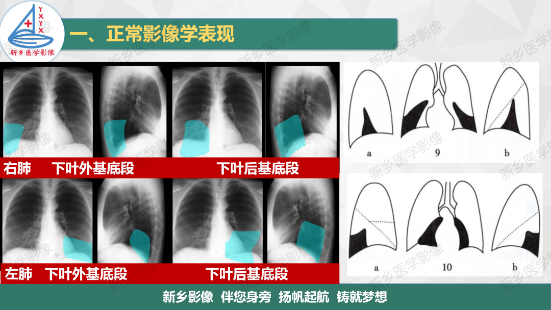 影像PPT - 【PPT】医学影像诊断学教材解读—呼吸系统疾病-20