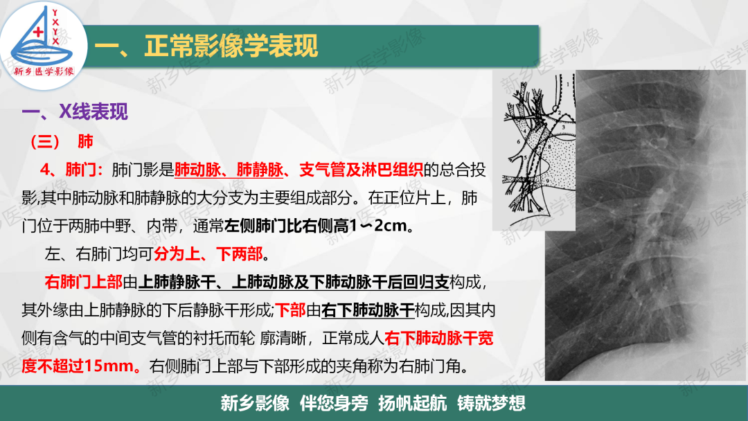 影像PPT - 【PPT】医学影像诊断学教材解读—呼吸系统疾病-21