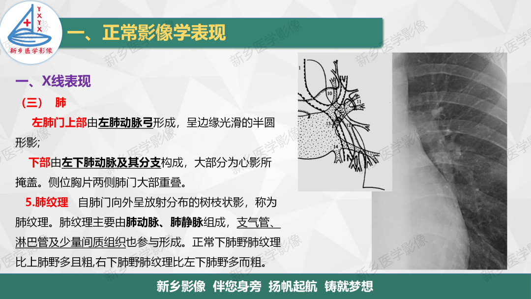影像PPT - 【PPT】医学影像诊断学教材解读—呼吸系统疾病-22