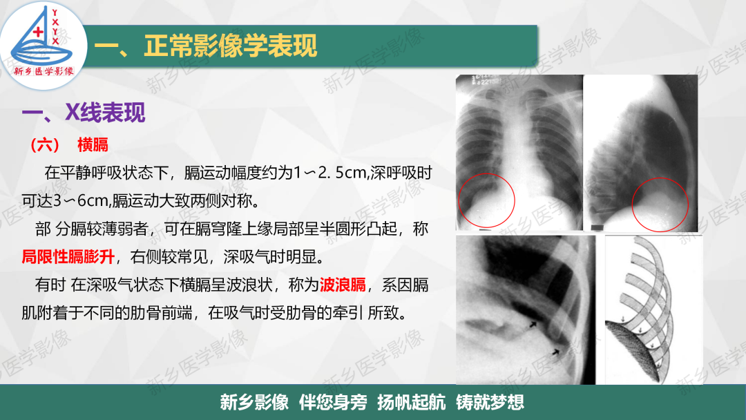 影像PPT - 【PPT】医学影像诊断学教材解读—呼吸系统疾病-26