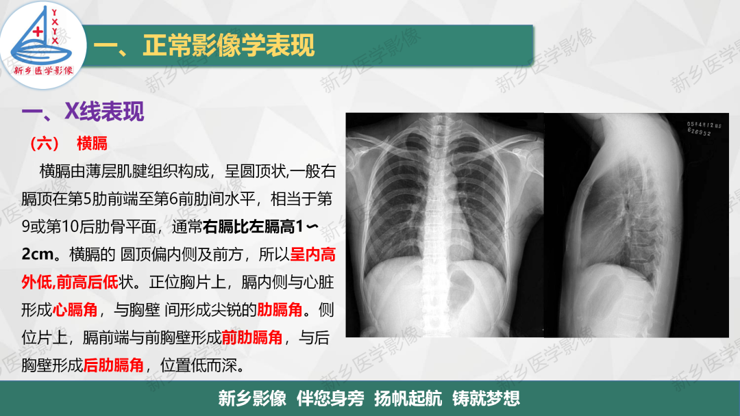 影像PPT - 【PPT】医学影像诊断学教材解读—呼吸系统疾病-25