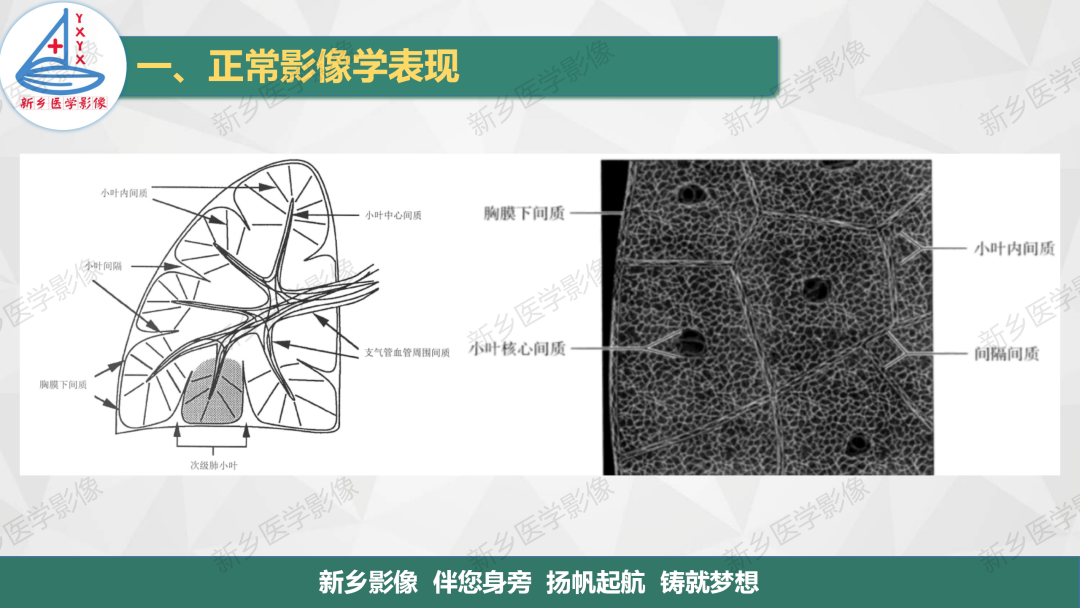 影像PPT - 【PPT】医学影像诊断学教材解读—呼吸系统疾病-30
