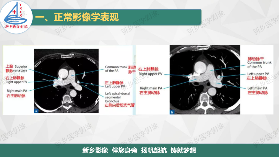 影像PPT - 【PPT】医学影像诊断学教材解读—呼吸系统疾病-33