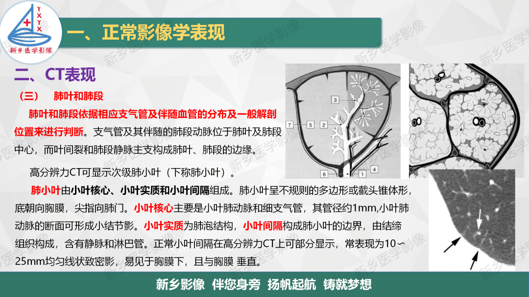影像PPT - 【PPT】医学影像诊断学教材解读—呼吸系统疾病-29