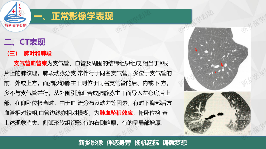 影像PPT - 【PPT】医学影像诊断学教材解读—呼吸系统疾病-31