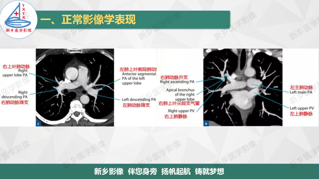 影像PPT - 【PPT】医学影像诊断学教材解读—呼吸系统疾病-34