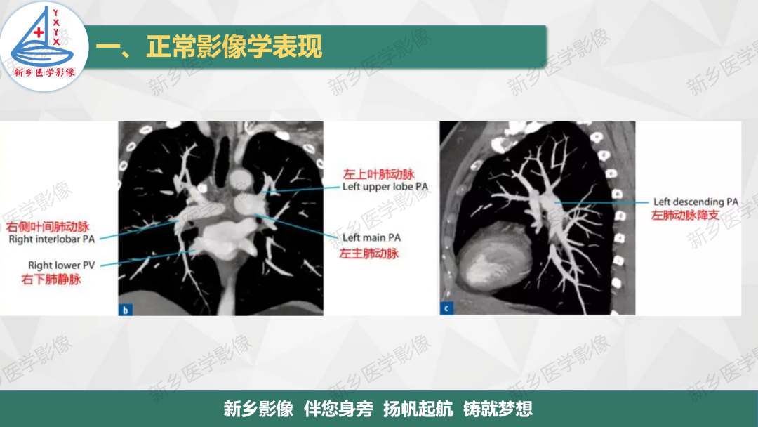 影像PPT - 【PPT】医学影像诊断学教材解读—呼吸系统疾病-35