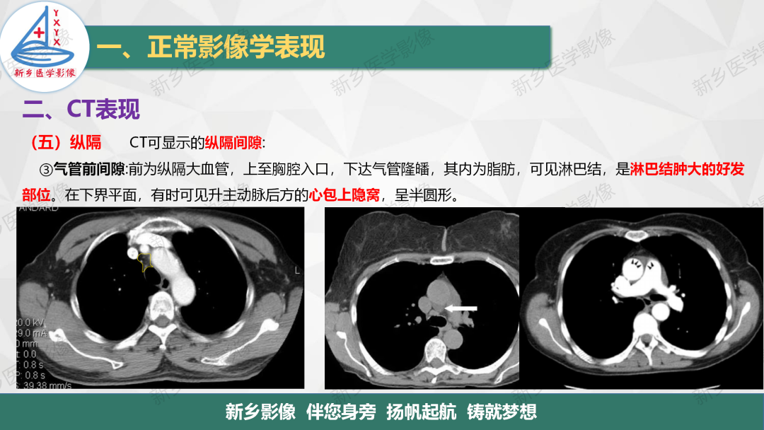 影像PPT - 【PPT】医学影像诊断学教材解读—呼吸系统疾病-38