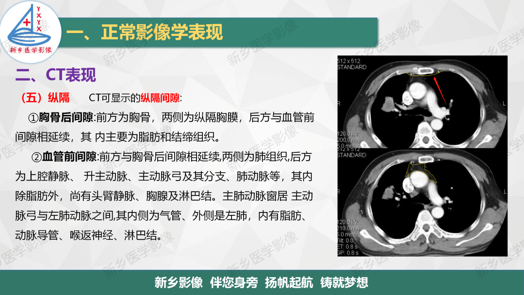 影像PPT - 【PPT】医学影像诊断学教材解读—呼吸系统疾病-37