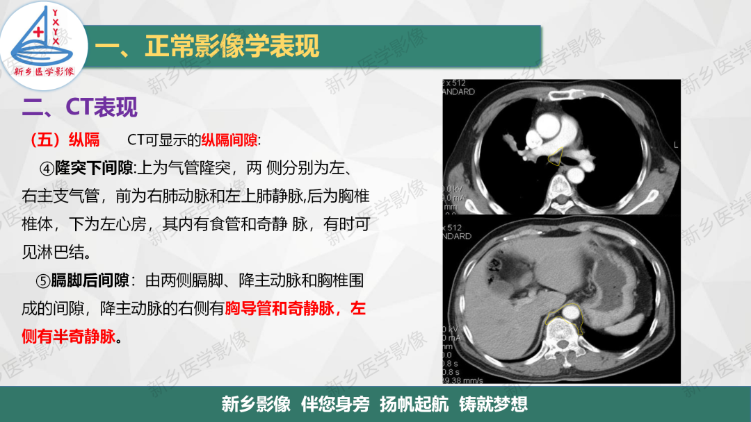 影像PPT - 【PPT】医学影像诊断学教材解读—呼吸系统疾病-39
