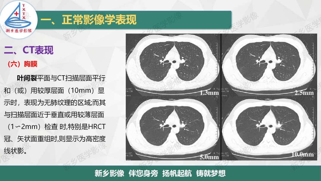 影像PPT - 【PPT】医学影像诊断学教材解读—呼吸系统疾病-40