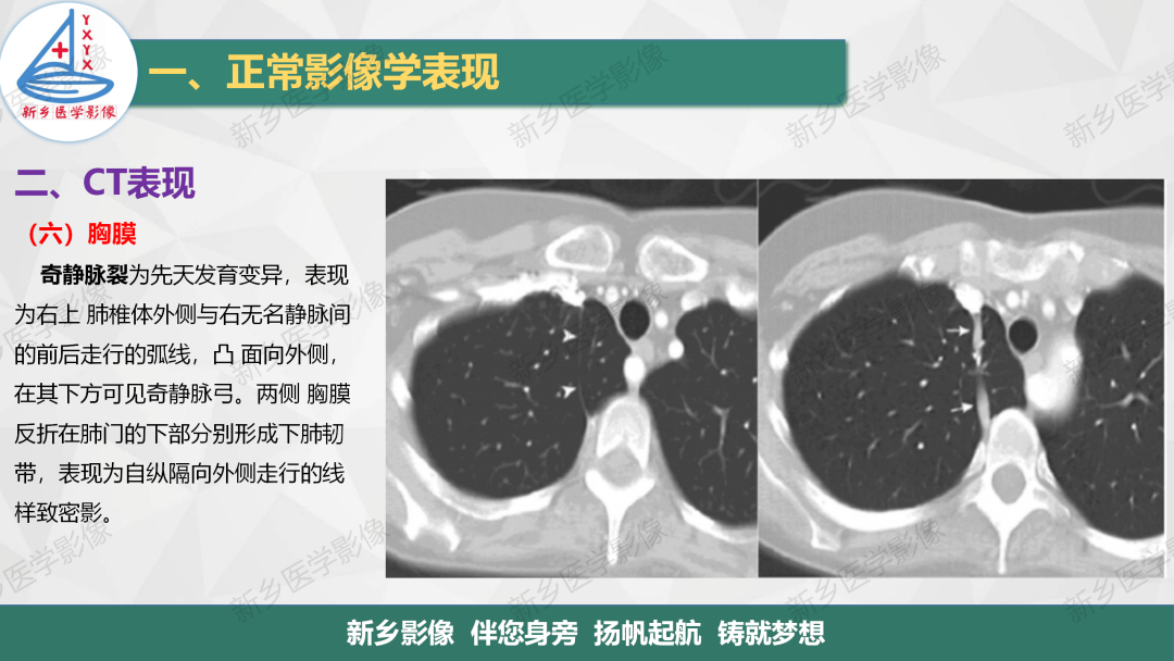 影像PPT - 【PPT】医学影像诊断学教材解读—呼吸系统疾病-41