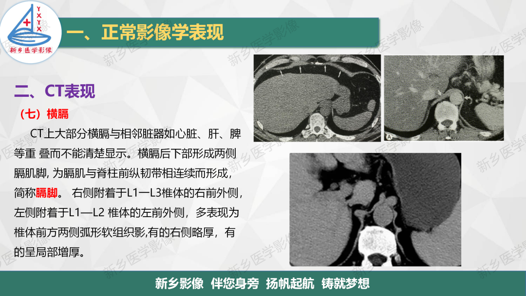 影像PPT - 【PPT】医学影像诊断学教材解读—呼吸系统疾病-42
