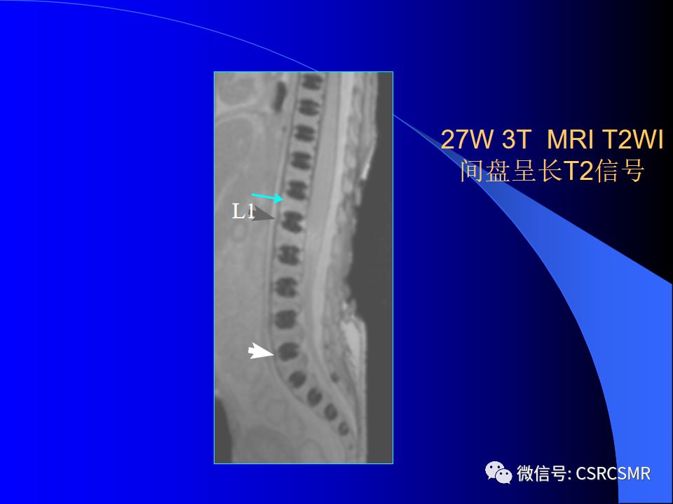 影像PPT - 【PPT】椎间盘发育、退变与病变MRI表现-9