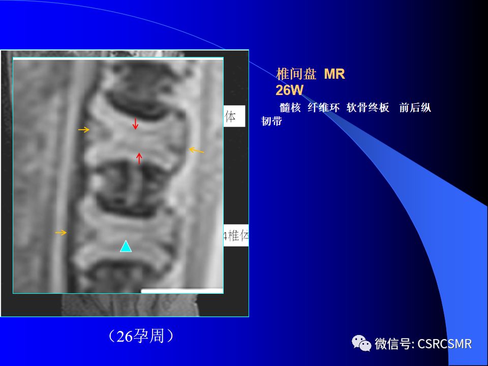 影像PPT - 【PPT】椎间盘发育、退变与病变MRI表现-10