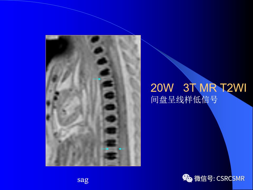 影像PPT - 【PPT】椎间盘发育、退变与病变MRI表现-8