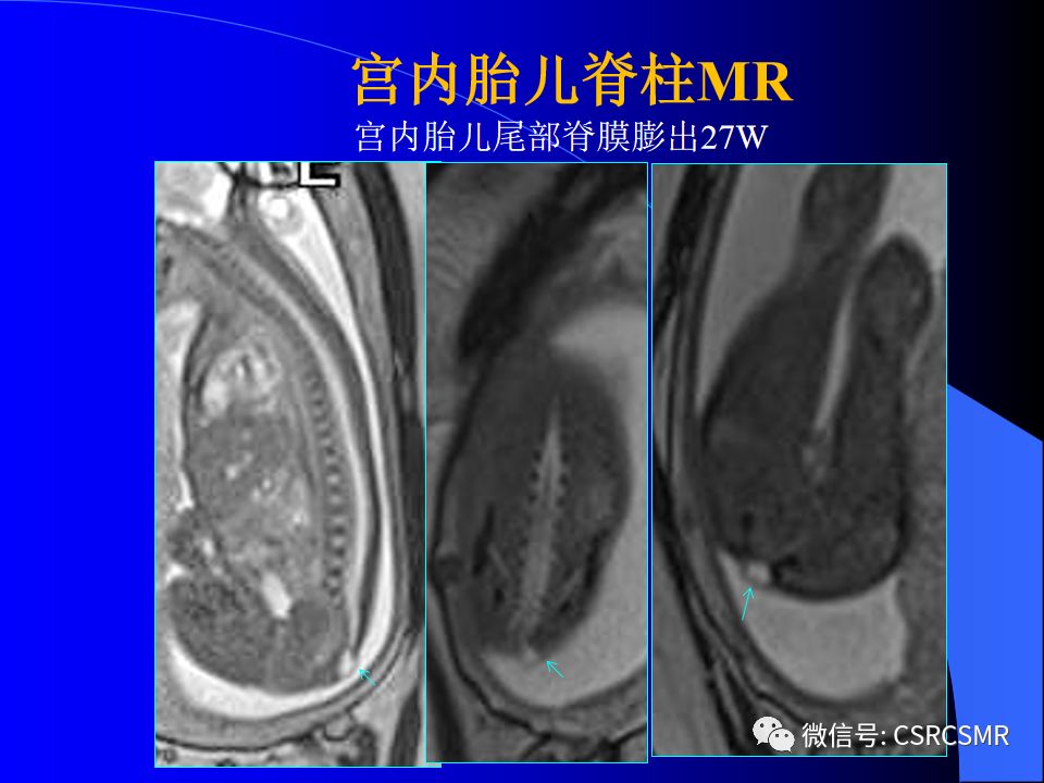 影像PPT - 【PPT】椎间盘发育、退变与病变MRI表现-11