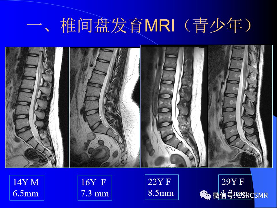 影像PPT - 【PPT】椎间盘发育、退变与病变MRI表现-17