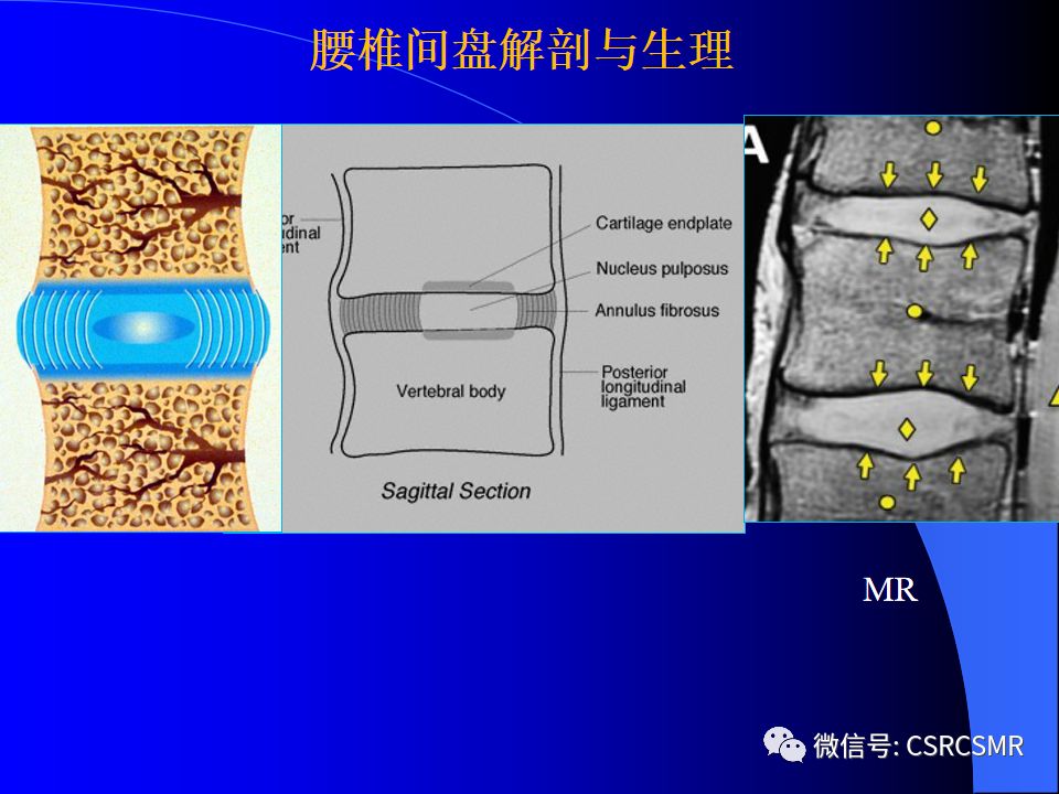 影像PPT - 【PPT】椎间盘发育、退变与病变MRI表现-14