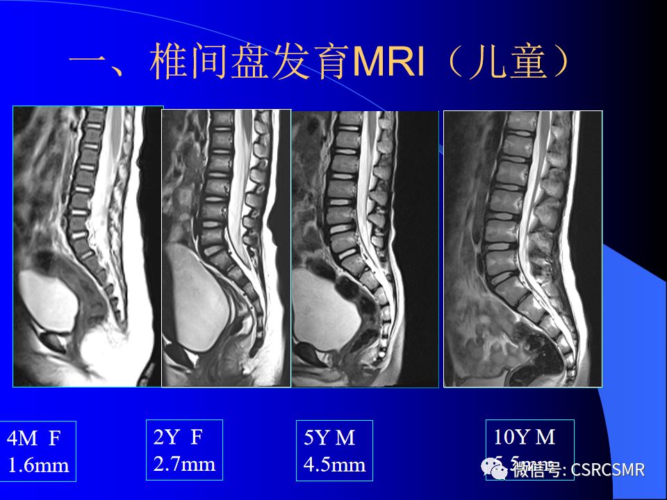 影像PPT - 【PPT】椎间盘发育、退变与病变MRI表现-16