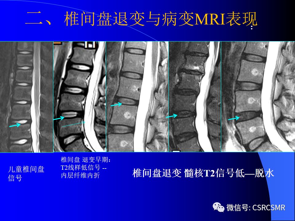 影像PPT - 【PPT】椎间盘发育、退变与病变MRI表现-19