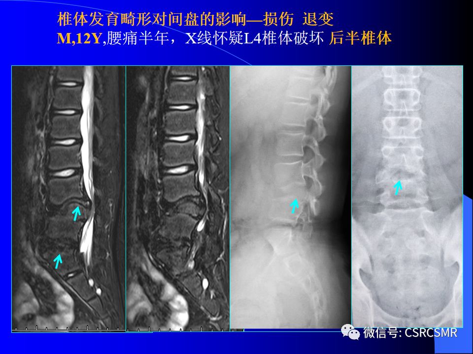 影像PPT - 【PPT】椎间盘发育、退变与病变MRI表现-21