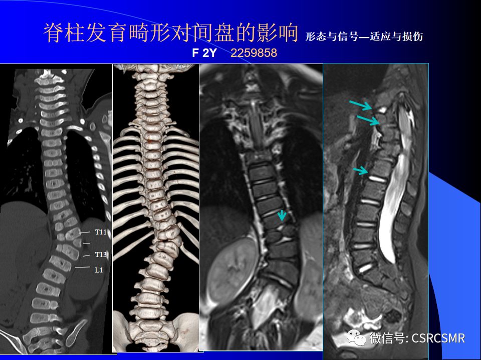 影像PPT - 【PPT】椎间盘发育、退变与病变MRI表现-20