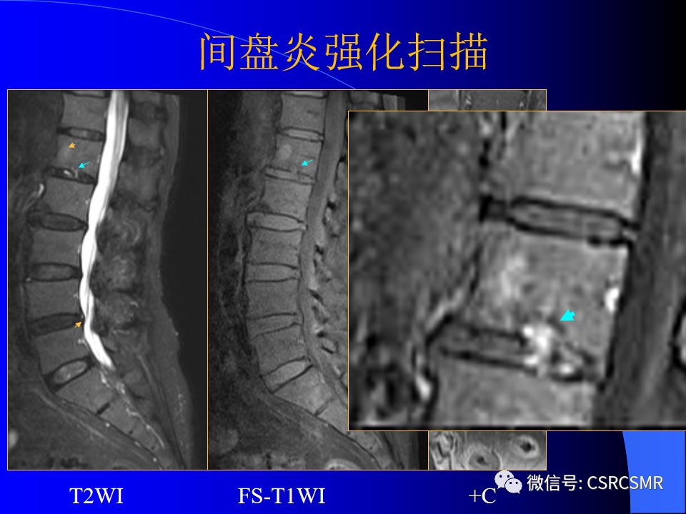影像PPT - 【PPT】椎间盘发育、退变与病变MRI表现-25