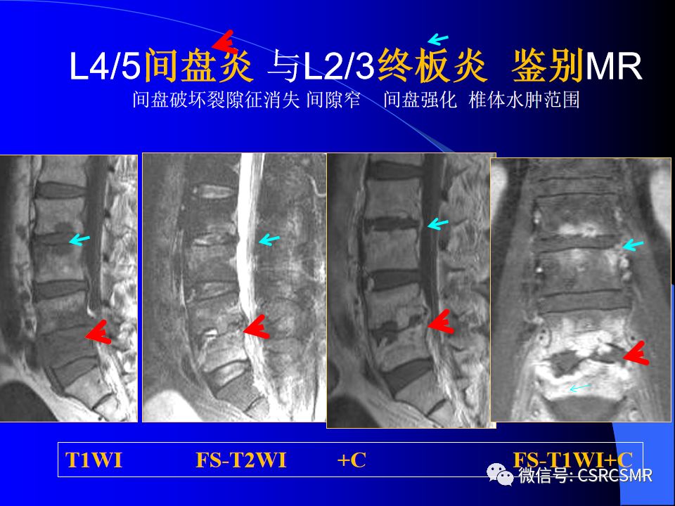 影像PPT - 【PPT】椎间盘发育、退变与病变MRI表现-24