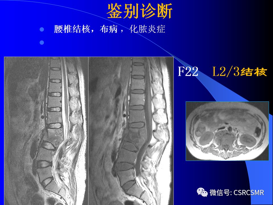 影像PPT - 【PPT】椎间盘发育、退变与病变MRI表现-27