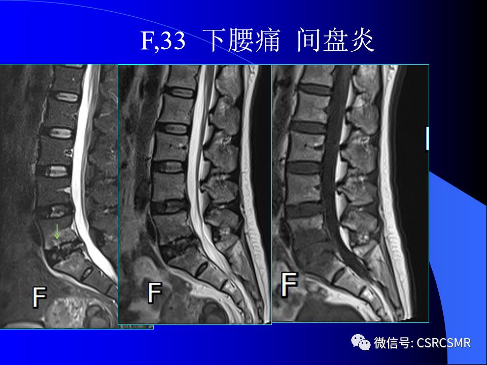 影像PPT - 【PPT】椎间盘发育、退变与病变MRI表现-26