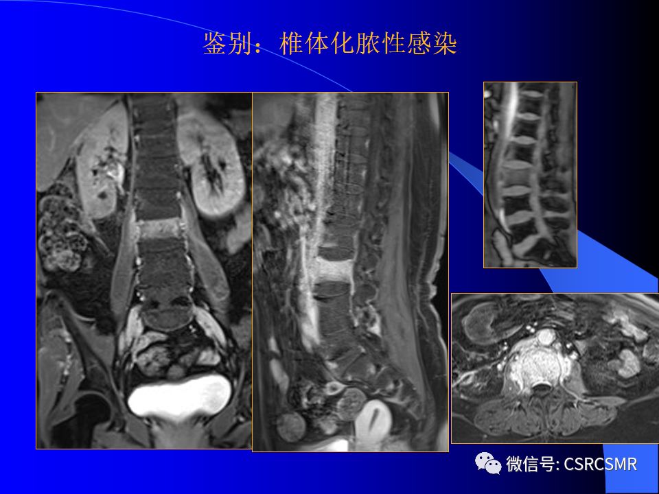 影像PPT - 【PPT】椎间盘发育、退变与病变MRI表现-31