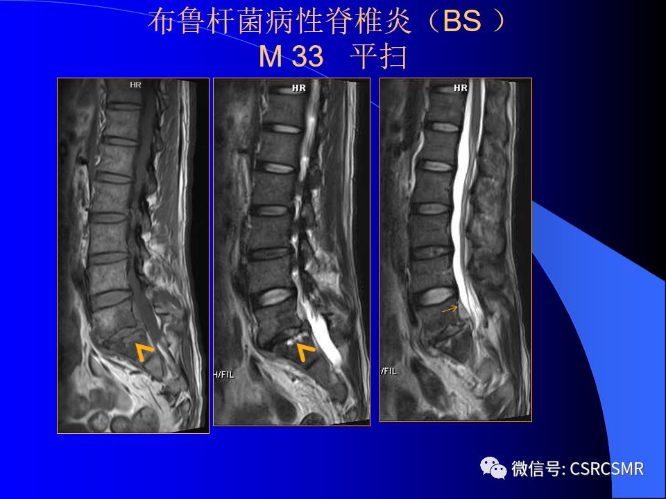 影像PPT - 【PPT】椎间盘发育、退变与病变MRI表现-28