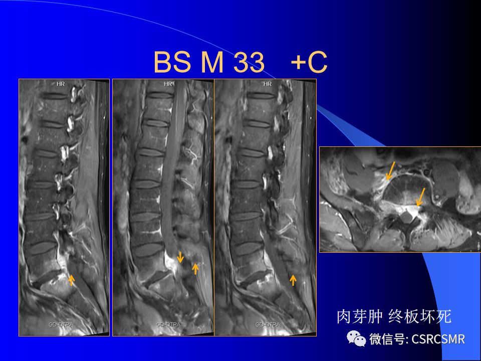 影像PPT - 【PPT】椎间盘发育、退变与病变MRI表现-29