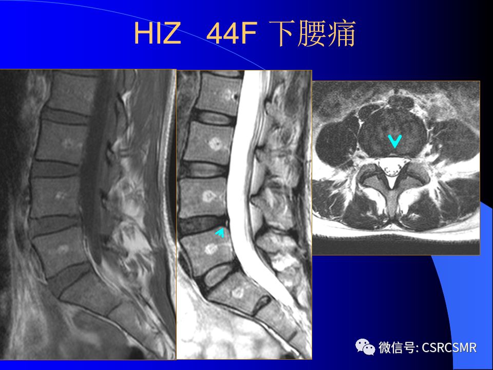 影像PPT - 【PPT】椎间盘发育、退变与病变MRI表现-34